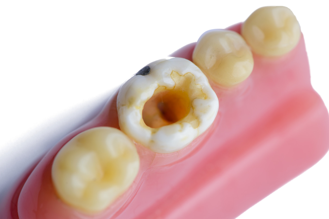 补牙材料的价格贵和便宜有什么区别,如:150和300或500和800元 - 口腔健康 - 毛毛网