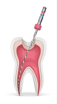 【牙医说第25期】牙齿坏死保不住？别急，先了解一下“牙髓再生术”