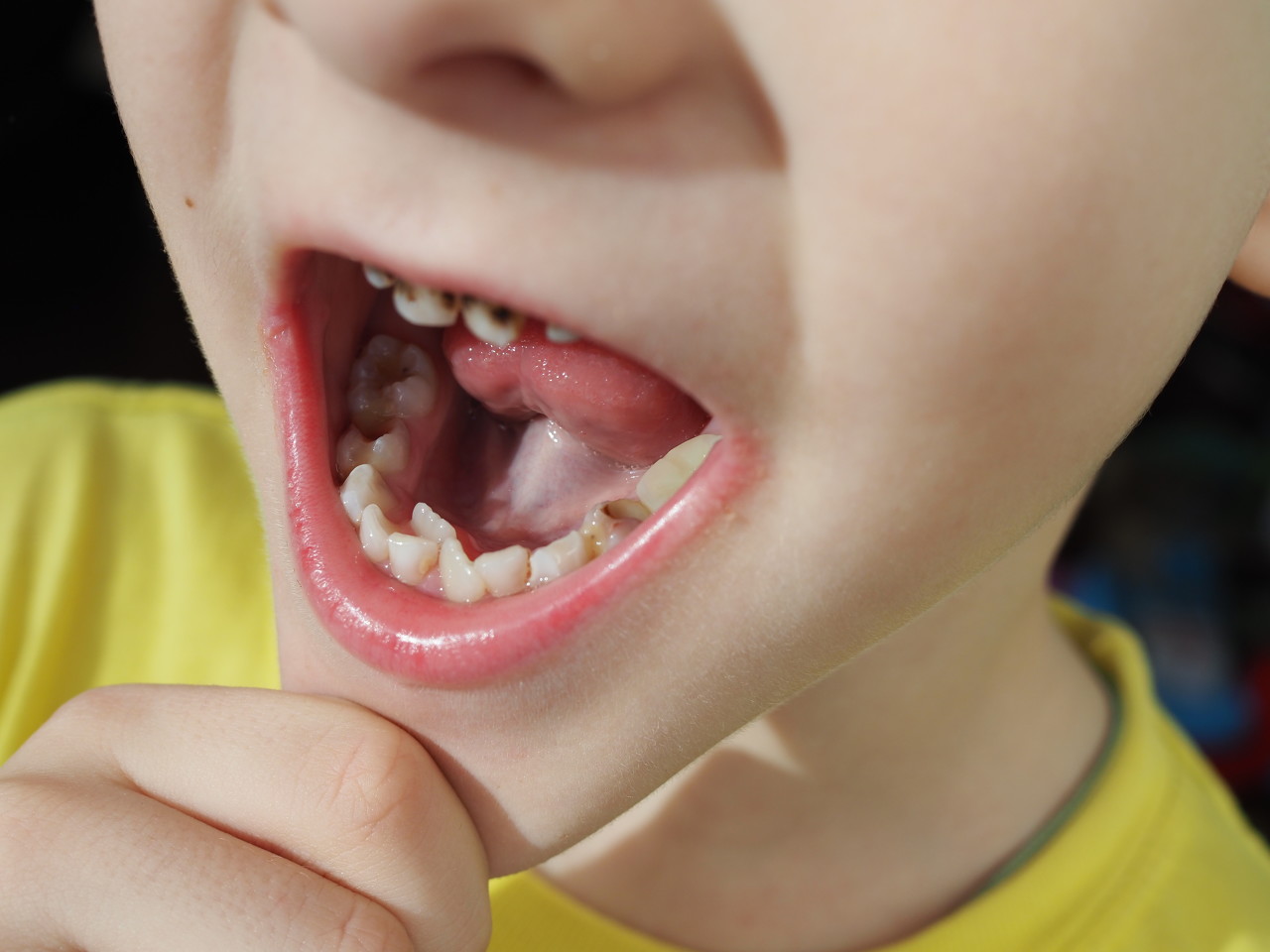 Early Childhood Caries | Toddler Tooth Decay