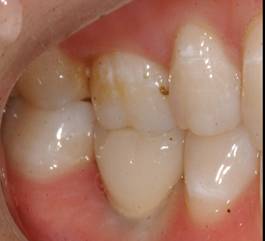 后牙种植案例