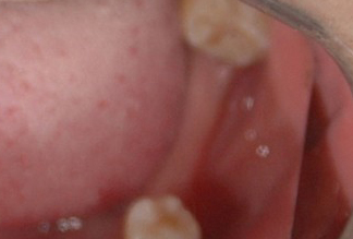 后牙种植案例