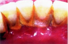 牙龈萎缩引发牙痛问题详解