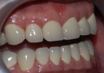 牙齿拔除要多久才能做种植牙