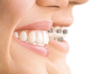 牙齿矫正期间清理口腔的方法