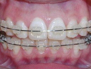 牙齿矫正的过程是怎么样的？