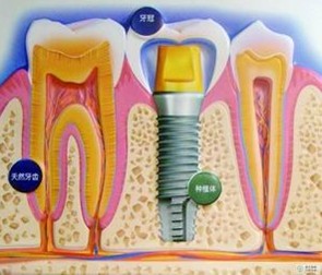 种植牙要多少钱