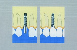 种植牙手术