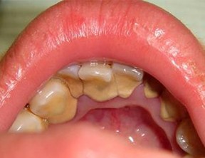 牙结石的危害
