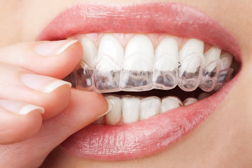 牙齿矫正过程会疼是怎么回事? 