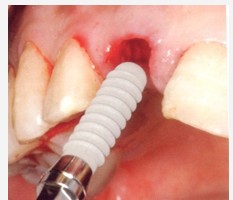 前牙缺失怎么做牙