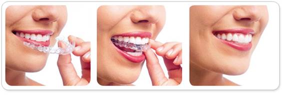 常用的牙齿矫正方法？