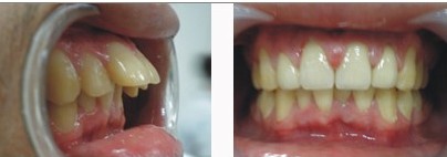 牙齿矫正反弹的原因是什么？