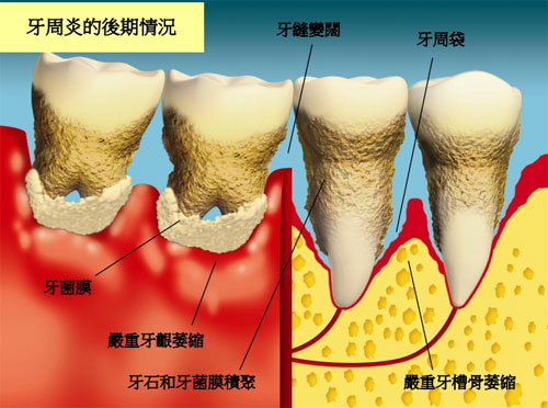 什么原因会引致剧烈牙痛？