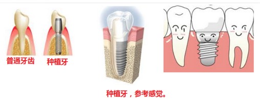 种植牙和镶牙，应该如何选择？