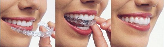 外科正牙不减少牙齿寿命?