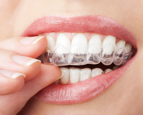 牙齿拥挤有哪些危害？