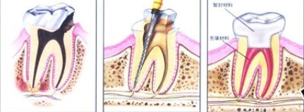 什么情况下该做牙齿的根管治疗?