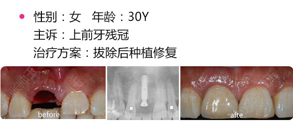 深圳种植牙手术多少钱?
