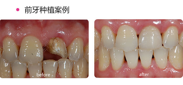 种植牙与传统假牙比具有哪些优势