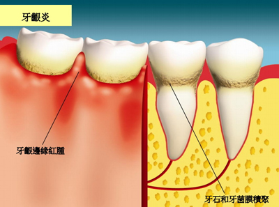 牙龈炎是怎么引起的？