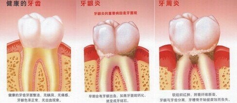 牙龈红肿是牙龈炎还是牙周炎？