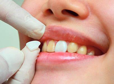 牙齿贴面哪种效果好？
