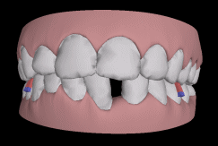 矫牙期间出现疼痛是正常的吗？