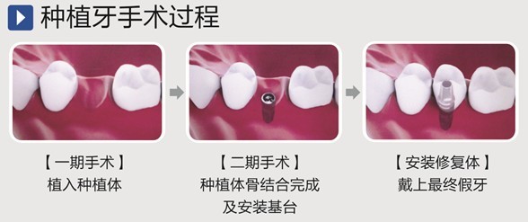 宝威体育官网：宝威体育：英国新发明自然修复龋齿将使牙钻退休牙刷落伍