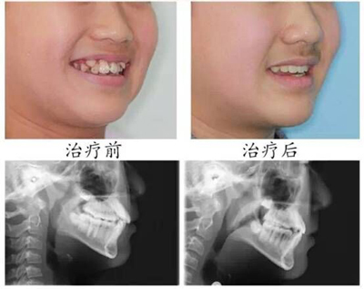 儿童牙齿不齐有什么影响？