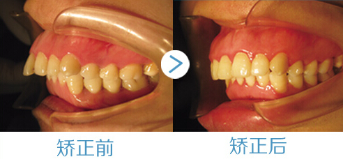 龅牙的危害有哪些？