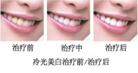 哪些类型的牙齿适合做冷光美白？