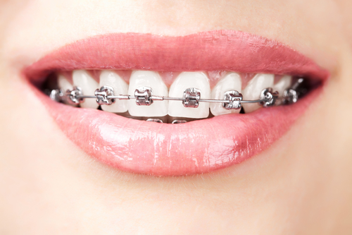 牙齿矫正会造成牙齿松动吗？