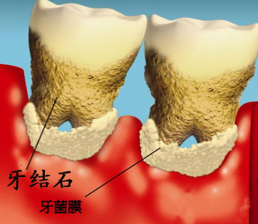 牙结石会造成哪些危害？