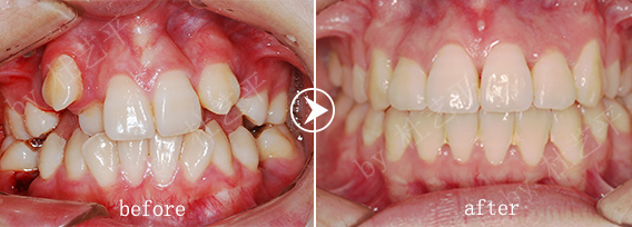 造成牙齿拥挤的原因有哪些？