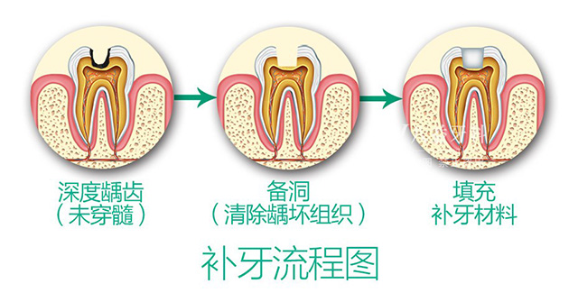补牙的手术过程要多久？