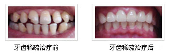 牙齿稀疏如何治疗？