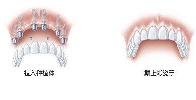 全口种植牙有哪些需要注意的？