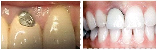 烤瓷牙对牙齿的伤害有哪些？