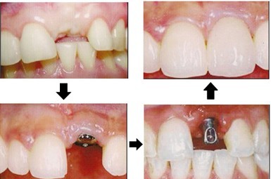 牙齿缺失应该怎么治疗？