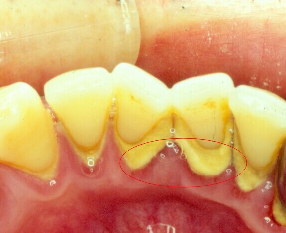 哪些方法可以预防牙结石？