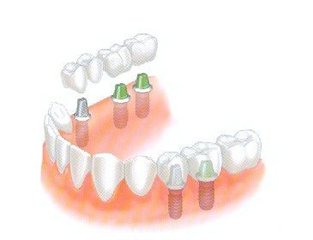 多颗牙做种植牙选什么材料好？