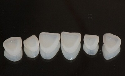 瓷贴面对牙齿有伤害吗？