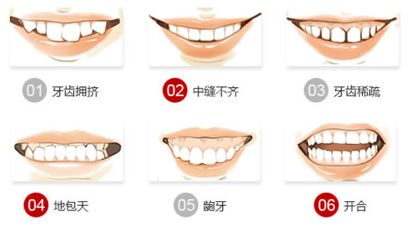 哪些牙齿问题需要进行矫正？