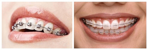 成人牙齿矫正较佳时期是什么？