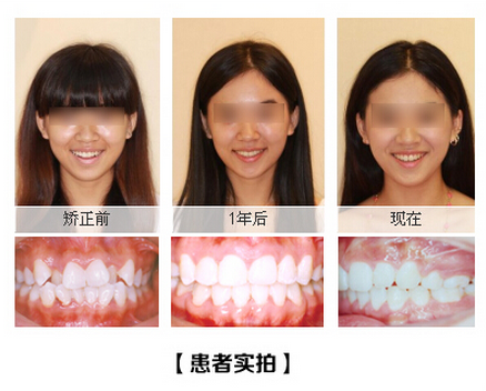 成人牙齿畸形能矫正吗？