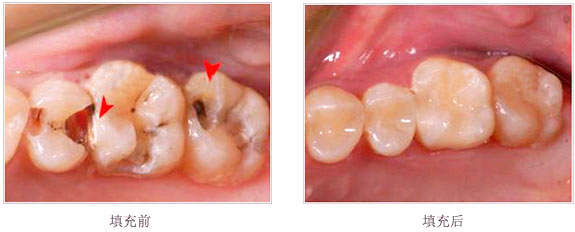 补过的牙齿能用多久？