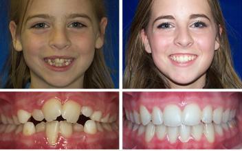 儿童牙齿不齐的危害有哪些？
