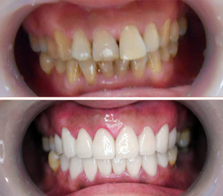 四环素牙采用哪种美白方式比较好？
