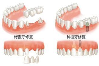 种植牙与传统的镶牙有何区别？