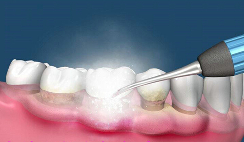 洗牙能解决牙龈出血问题吗？